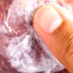 Bruises Popping Up Easily? Let’s Uncover Why!