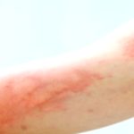 Mystery Rash: Why It Comes and Goes Mystery Rash: Why It Comes and Goes