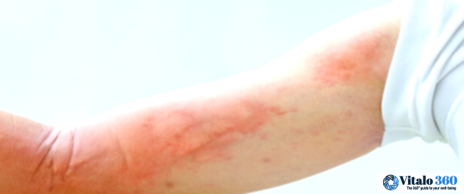 Mystery Rash: Why It Comes and Goes
