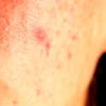 Clear Skin, Naturally: Your Guide to Acne Relief