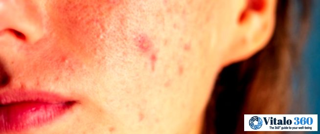 Clear Skin, Naturally: Your Guide to Acne Relief