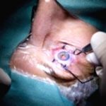 Considering Eyelid Surgery? Don't Skip These Crucial Tests! Considering Eyelid Surgery? Don’t Skip These Crucial Tests!