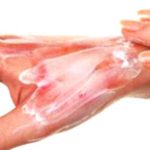 Understanding Burn Severity and First Aid