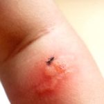 Mosquito Magnet? Find Out Why They Love You (and How to Dodge Them!) Mosquito Magnet? Find Out Why They Love You (and How to Dodge Them!)