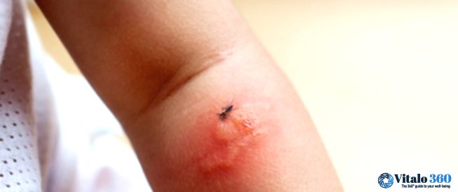 Mosquito Magnet? Find Out Why They Love You (and How to Dodge Them!)