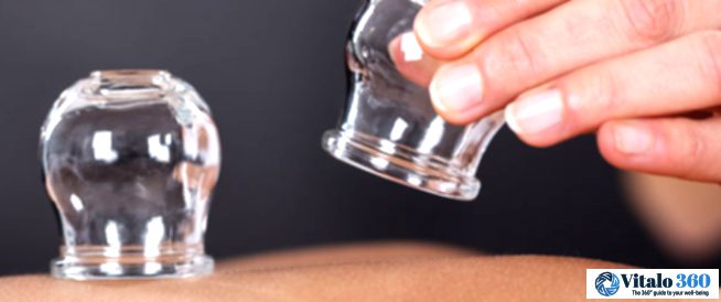 Cupping Therapy: Uncovering the Truth Behind the Hype.