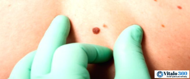 Skin Cancer Symptoms: What You Should Watch Out For