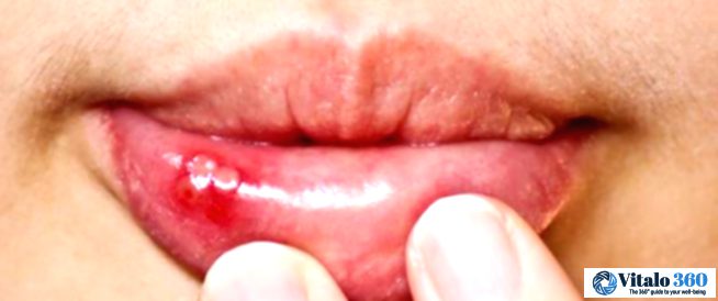Say Goodbye to Oral Thrush: Simple Treatment Options
