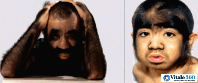 Werewolf Syndrome: Unmasking the Facts