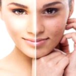 10 Amazing Home Remedies for Melasma Treatment