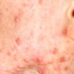 Acne Treatment: Medical Procedures That May Help You