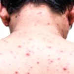 Back Acne: Causes, Types, and Effective Treatment Back Acne: Causes, Types, and Effective Treatment