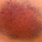 Bruise Colors: What They Mean for Your Health Bruise Colors: What They Mean for Your Health