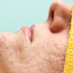 Acne Scars: Types, Causes, and Effective Treatments