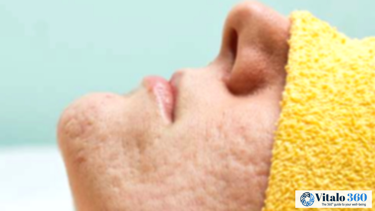 Acne Scars: Types, Causes, and Effective Treatments Acne Scars: Types, Causes, and Effective Treatments