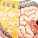 Colon Diseases: Cancer Leads the List Colon Diseases: Cancer Leads the List