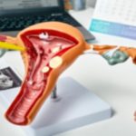 Endometrial Polyps: What You Need to Know