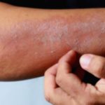 Erythroderma: Symptoms, Causes & Treatment Guide Erythroderma: Symptoms, Causes & Treatment Guide
