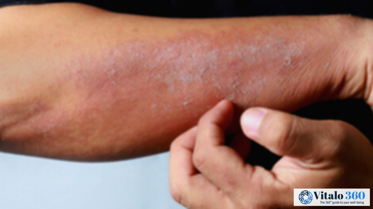 Erythroderma: Symptoms, Causes & Treatment Guide