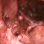 Rectal Cancer: Your Complete Guide