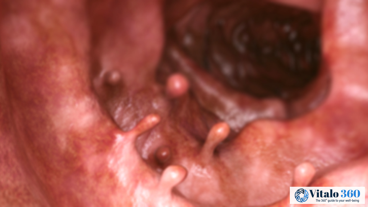 Rectal Cancer: Your Complete Guide