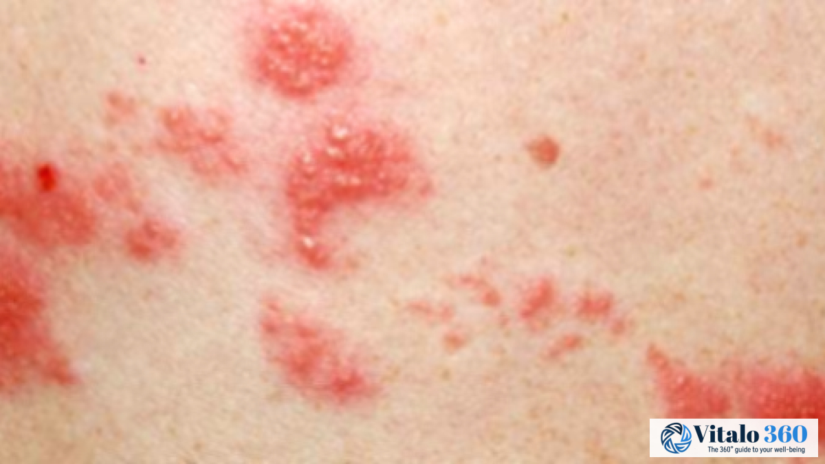Shingles: Symptoms, Causes, and Effective Treatments