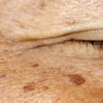 Treating Skin Pigmentation: Key Methods Explained