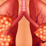 Understanding Stage 3 Lung Cancer: What You Need to Know Understanding Stage 3 Lung Cancer: What You Need to Know