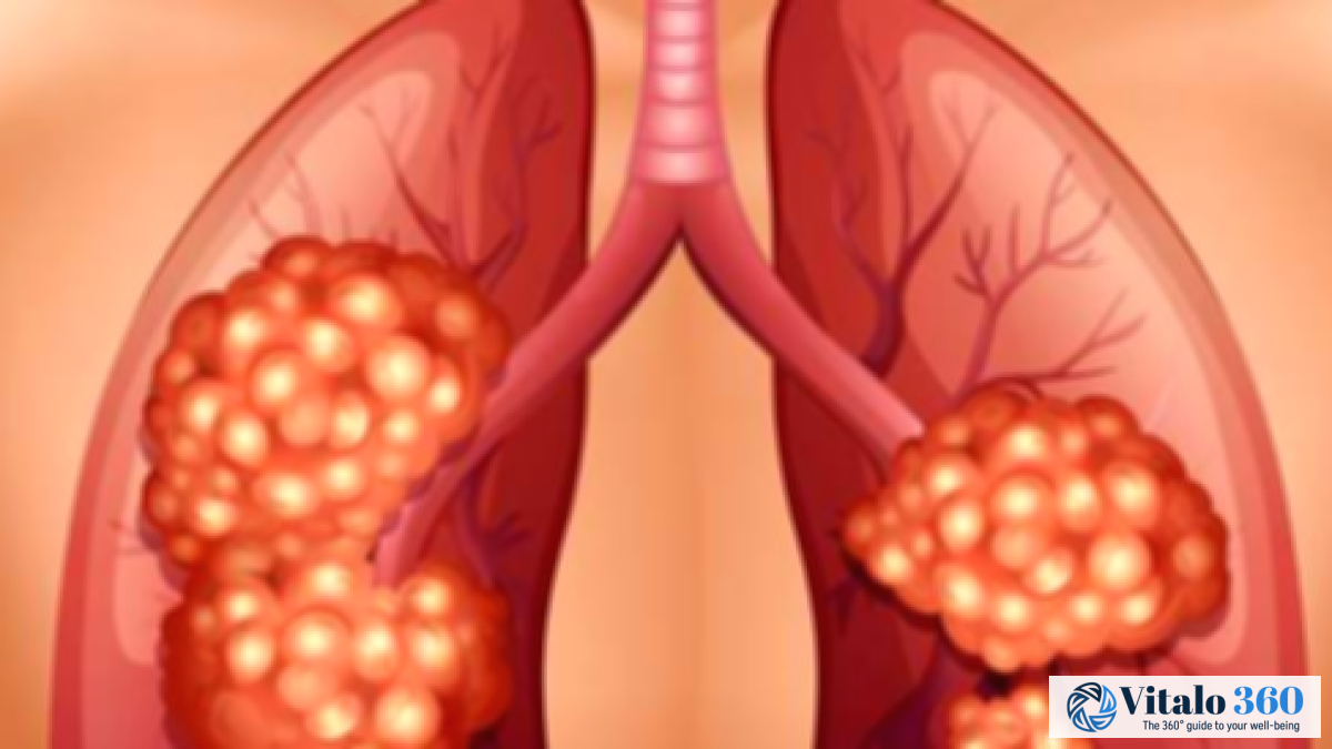 Understanding Stage 3 Lung Cancer: What You Need to Know Understanding Stage 3 Lung Cancer: What You Need to Know