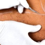 Weight Loss Surgery: A Simple Guide for Beginners