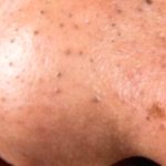 6 Effective Ways to Get Rid of Blackheads
