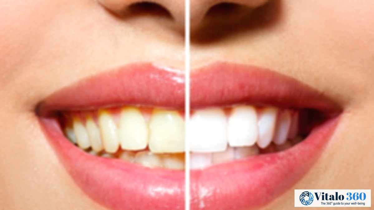 6 Simple Home Remedies for Whiter, Brighter Teeth