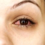 8 Causes of Red Eyes: What You Need to Know 8 Causes of Red Eyes: What You Need to Know