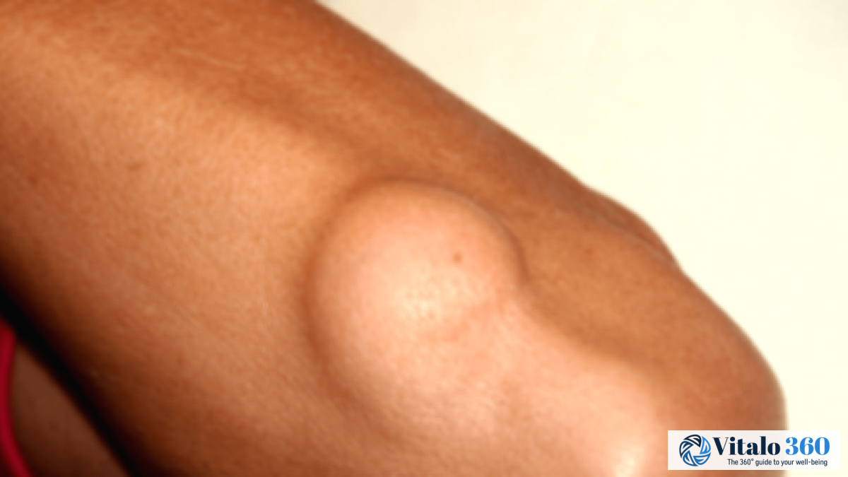 Benign Tumors: A Comprehensive Guide