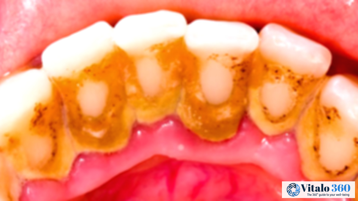Black Teeth: Causes & Simple Home Remedies