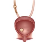 Bladder Stones: Key Facts You Need To Know Bladder Stones: Key Facts You Need To Know
