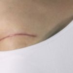 Breast Reconstruction After Mastectomy: What to Expect