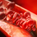 Calcification: Understanding Causes and Health Risks