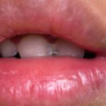 Chapped Lips Corner? Understand Causes and Treatments Chapped Lips Corner? Understand Causes and Treatments
