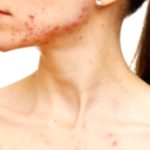 Chest Acne: Causes and Effective Treatment Options