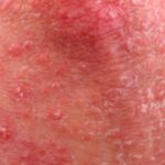 Chicken Skin: Causes, Symptoms, and Treatment Chicken Skin: Causes, Symptoms, and Treatment