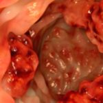 Colon Cancer Prevention: Simple Steps You Can Take