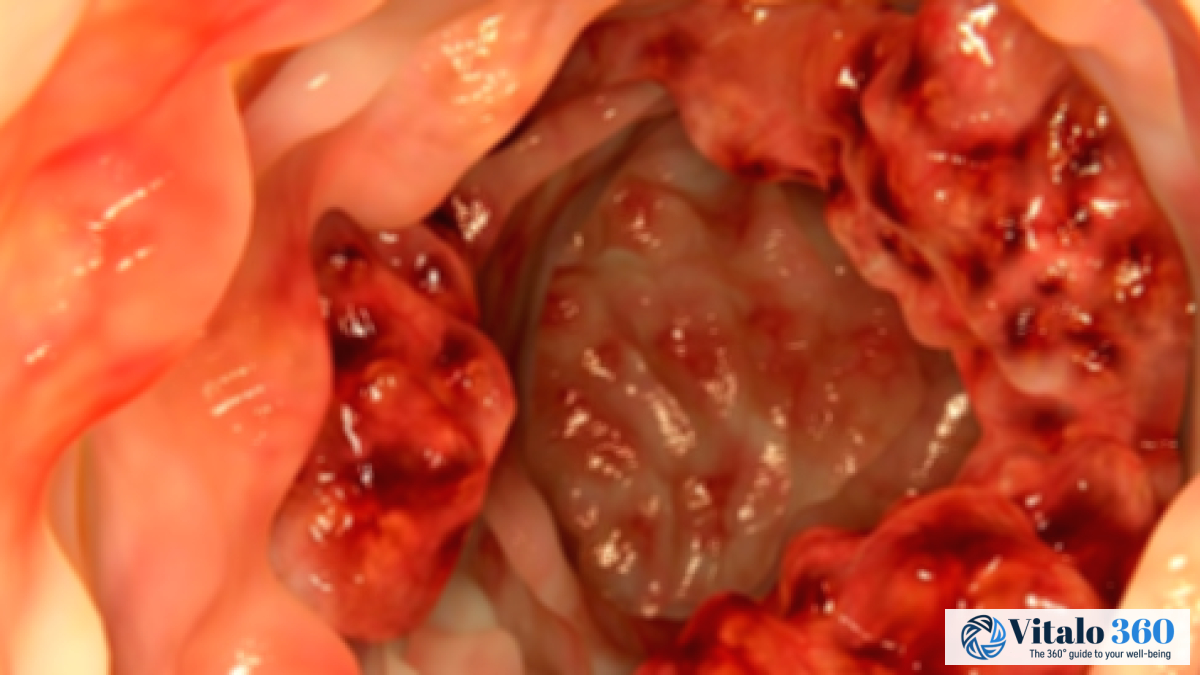 Colon Cancer Prevention: Simple Steps You Can Take