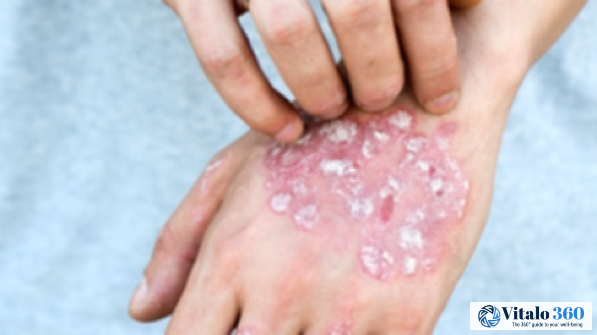 Eczema Relief at Home: Effective Treatment Options