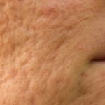 Effective Ways to Get Rid of Acne Scars and Pockmarks