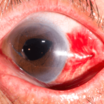 Eye Stroke: Causes, Symptoms, and Treatment Options