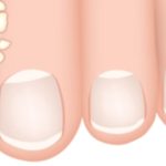 Foot Fungus Facts: What You Need to Know Now