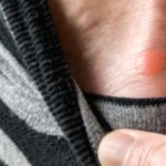 Foot Pimples: Key Facts and How to Treat Them Foot Pimples: Key Facts and How to Treat Them