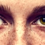 Freckles: Causes and Natural Remedies for Treatment Freckles: Causes and Natural Remedies for Treatment