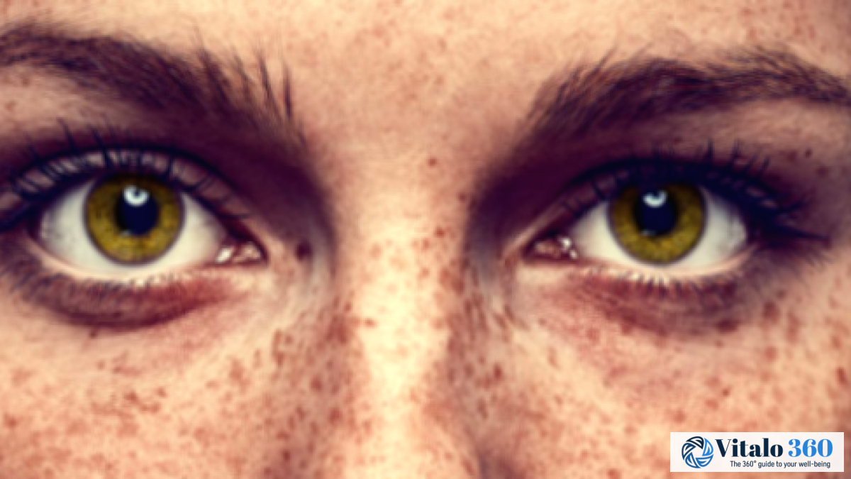 Freckles: Causes and Natural Remedies for Treatment Freckles: Causes and Natural Remedies for Treatment